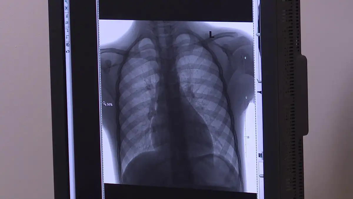 легкие больного туберкулезом на флюорографии