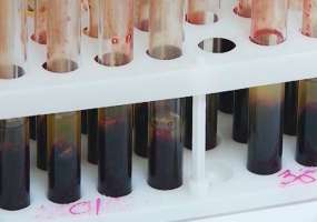 В Нижнекамске только 23 процента ВИЧ-инфицированных проходят противовирусное лечение - НТР 24