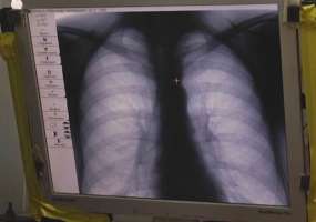 В Нижнекамске 6 детей заразились туберкулезом в 2018 году - НТР 24