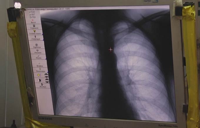 В Нижнекамске за неделю 32 человека заболели пневмонией