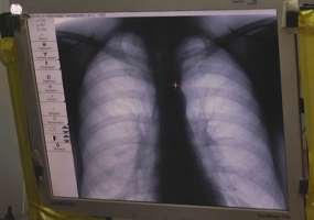 В Нижнекамске за неделю 32 человека заболели пневмонией - НТР 24