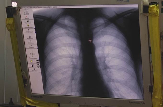 Более 20 детей в Нижнекамске заболели пневмонией