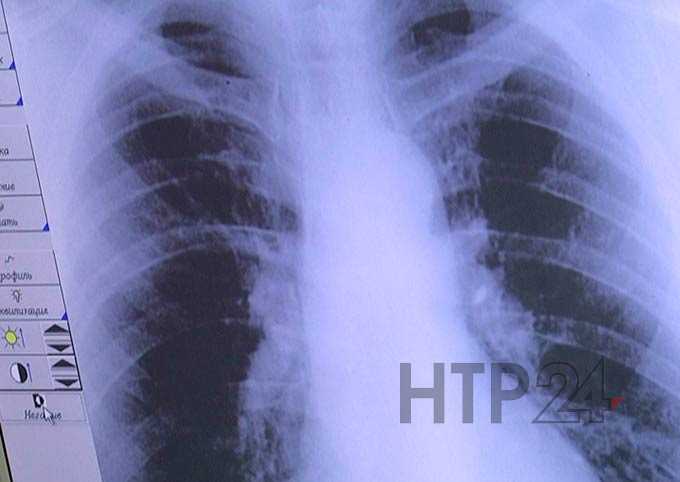 Роспотребнадзор НМР открыл "горячую линию" по вопросам профилактики туберкулеза