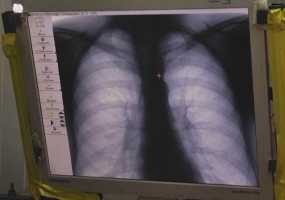 Более 20 детей в Нижнекамске заболели пневмонией - НТР 24