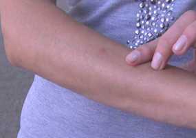 По какому принципу комары кусают людей - НТР 24