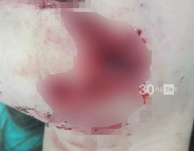 В Челнах бойцовская собака разорвала лицо 11-летней девочке