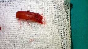 В Татарстане у женщины в носу жил жук - НТР 24