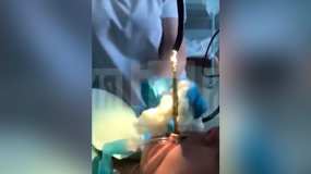 СМИ: Спящей россиянке заполза в рот метровая змея — медики вытащили её и сняли на видео