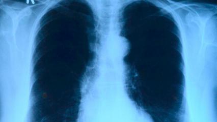 Минздрав: у перенесших коронавирус пациентов высок риск заболеть туберкулёзом
