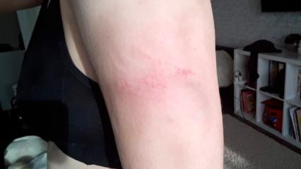 «Зоозащитники, я вас поздравляю»: в Нижнекамске около детсада девушку укусила собака