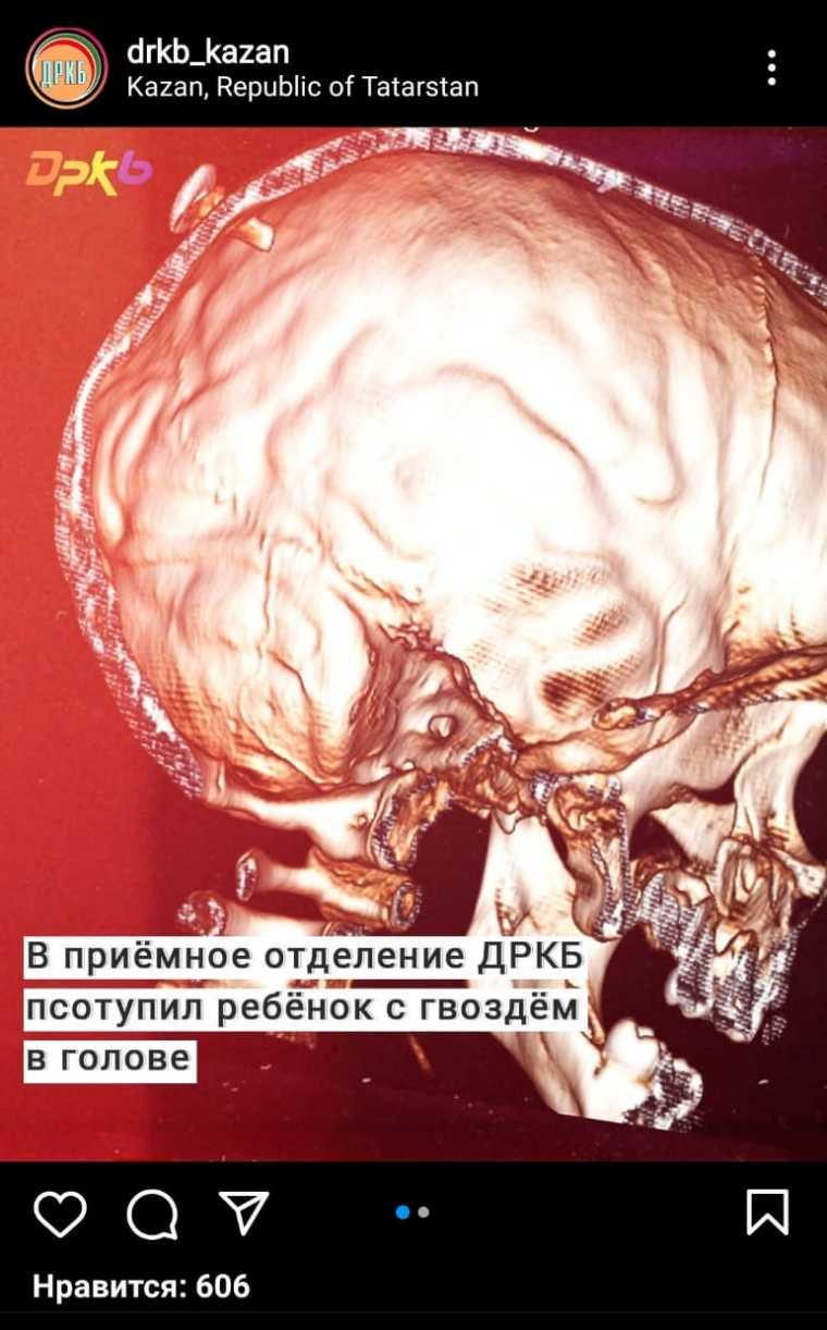 Результат томографии черепа ребенка 