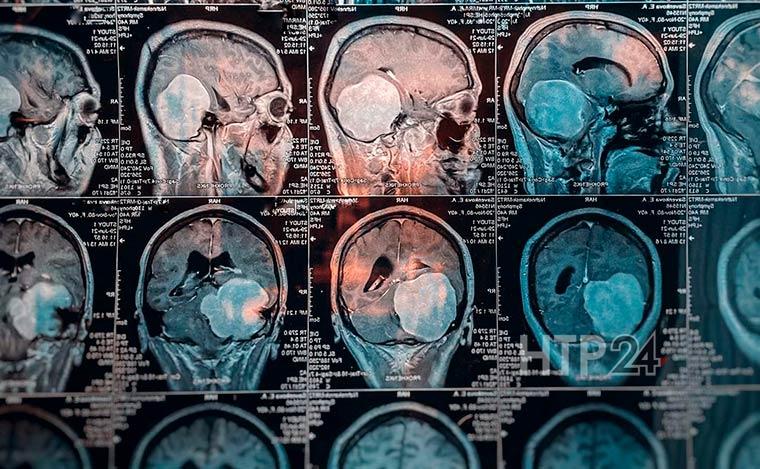 У нянечки из Нижнекамска удалили огромную опухоль в мозгу
