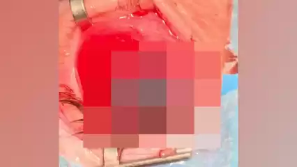 В Челнах девочке в глаз вонзилась кость, которую бросила ее младшая сестра - НТР 24