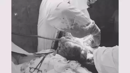 В Нижнекамске врачи удалили пожилой пациентке 14-килограммовую опухоль в брюшной полости