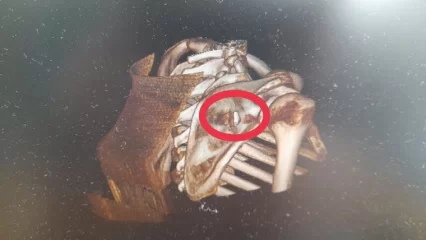 Нижнекамский хирург вытащил осколок у раненого на СВО бойца - НТР 24