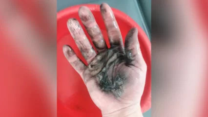 В Нижнекамске молодой человек пострадал от взорвавшейся в руке электронной сигареты - НТР 24