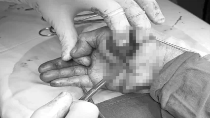 Нижнекамец чуть не отрезал себе палец «болгаркой», врачи НЦРМБ восстановили его руку - НТР 24