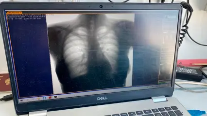 В Нижнекамске за 2023 год благодаря флюорографии выявили 32 случая туберкулеза