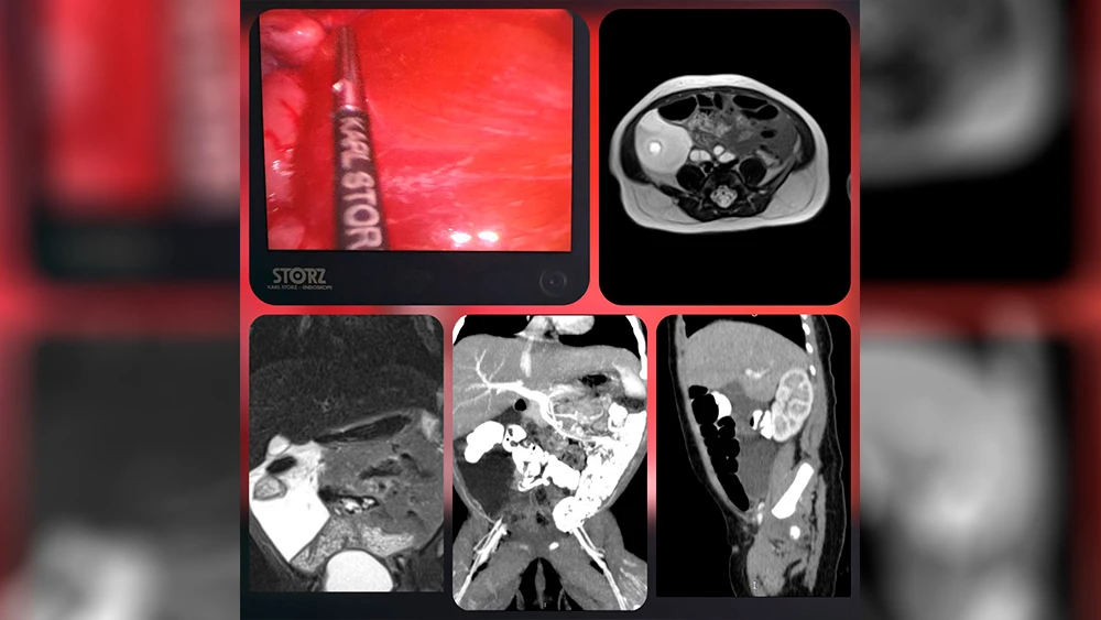 удаление лимфатической мальформации с сохранением сосудов брыжейки