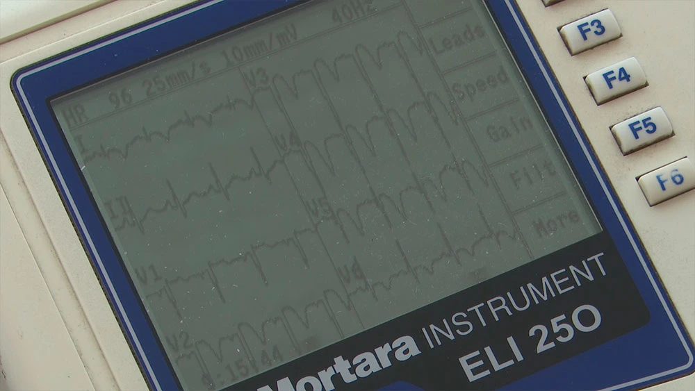 результат электрокардиограммы