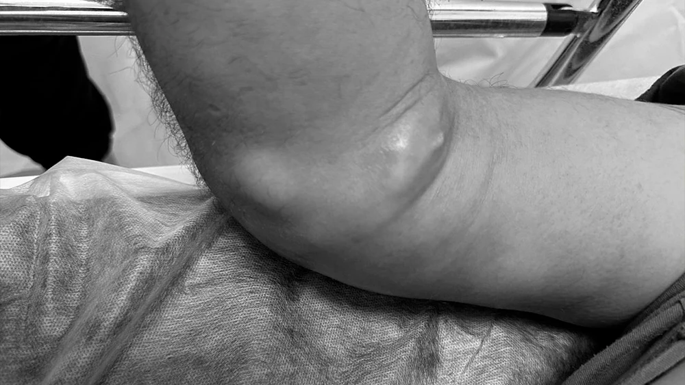 Опухшая рука