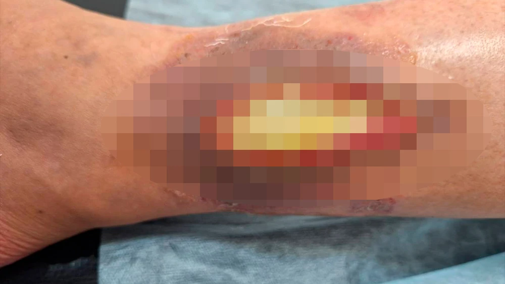 Последствия укуса кошки