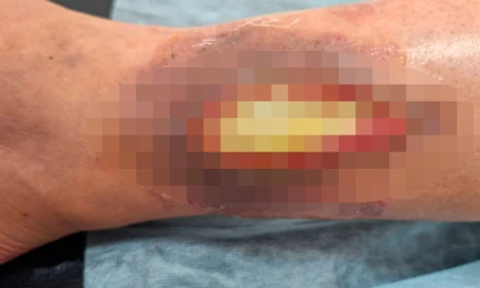 Нижнекамец третий месяц лечится после укуса кошки, его отправили в РКБ - НТР 24