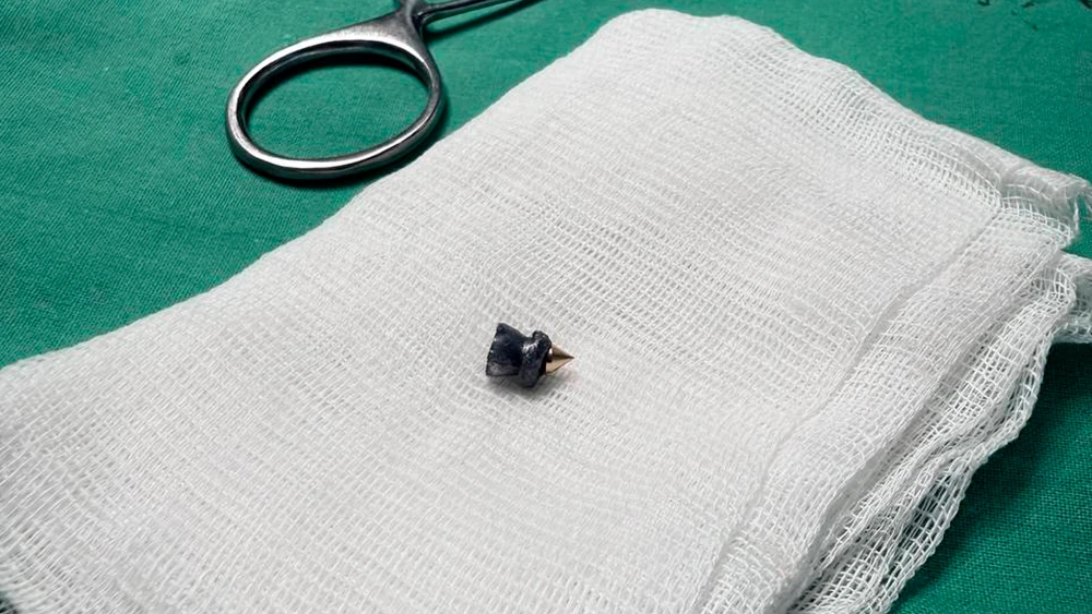 пуля извлечённая из шеи молодого человека в которого случайно выстрелило ружье в Зеленодольске