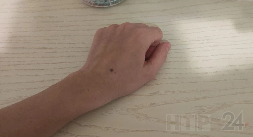 родинка на руке