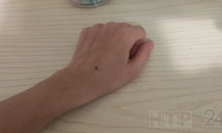 Врач-дерматовенеролог объяснила, когда можно удалять родинки - НТР 24