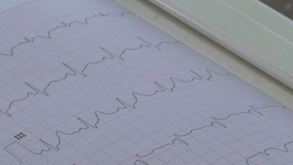 электрокардиограмма