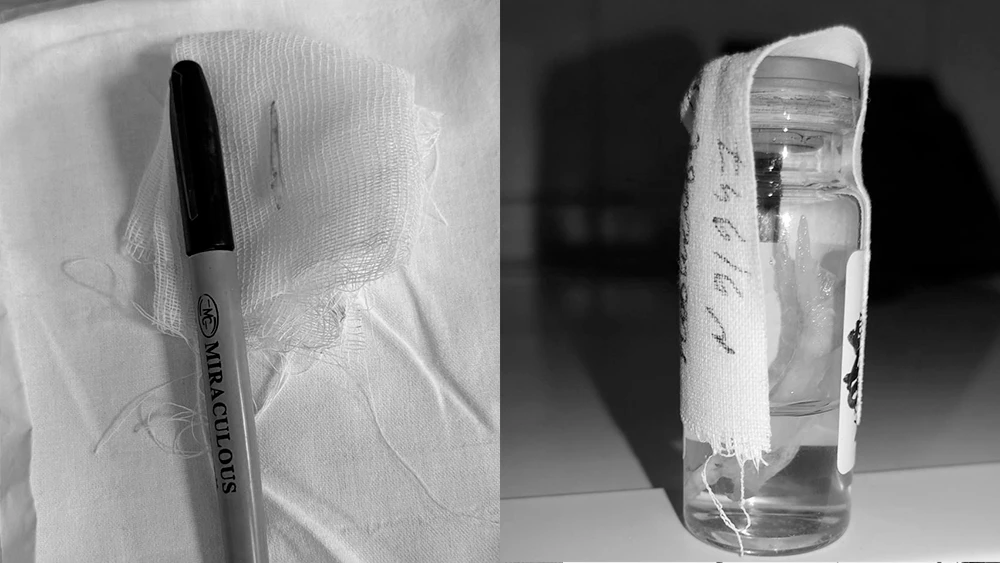 Кости рыбы в горле