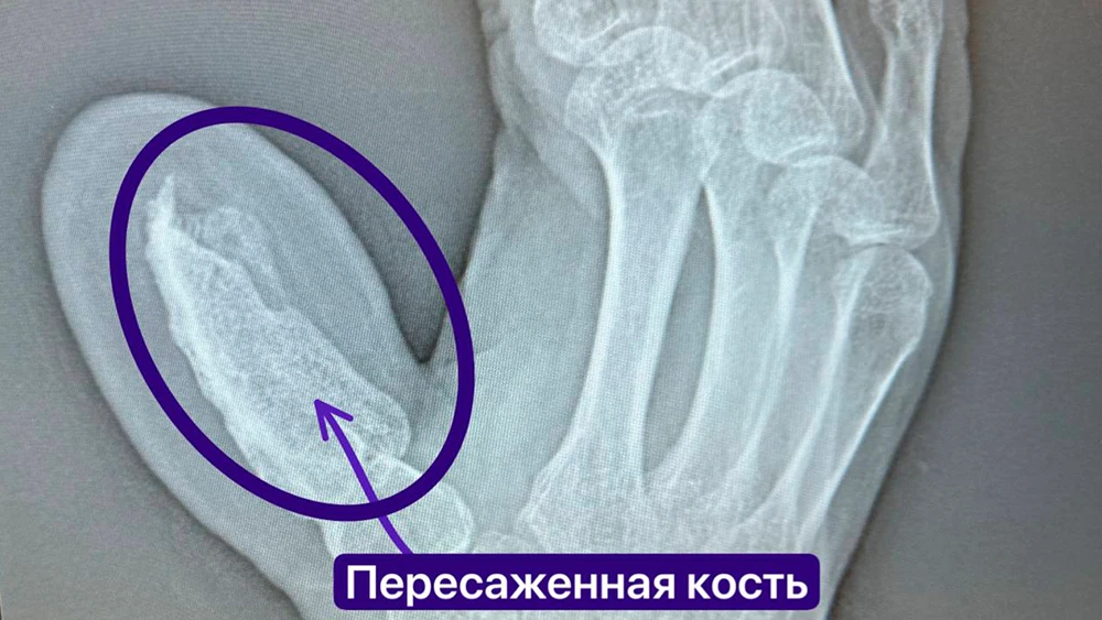 Рентген руки с пересаженной костью