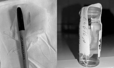 Хирурги РКБ Татарстана извлекли рыбьи кости из пищевода двух пациенток - НТР 24