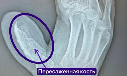 Микрохирурги РКБ Татарстана вырастили палец жителю Челнов - НТР 24