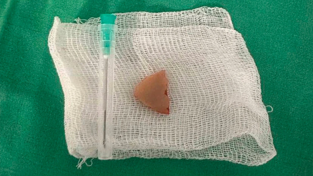 Застрявшая в лёгком татарстанца баранья кость