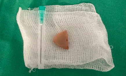 В Татарстане у мужчины застряла баранья кость в лёгком, ему помогли хирурги РКБ - телеканал НТР 24