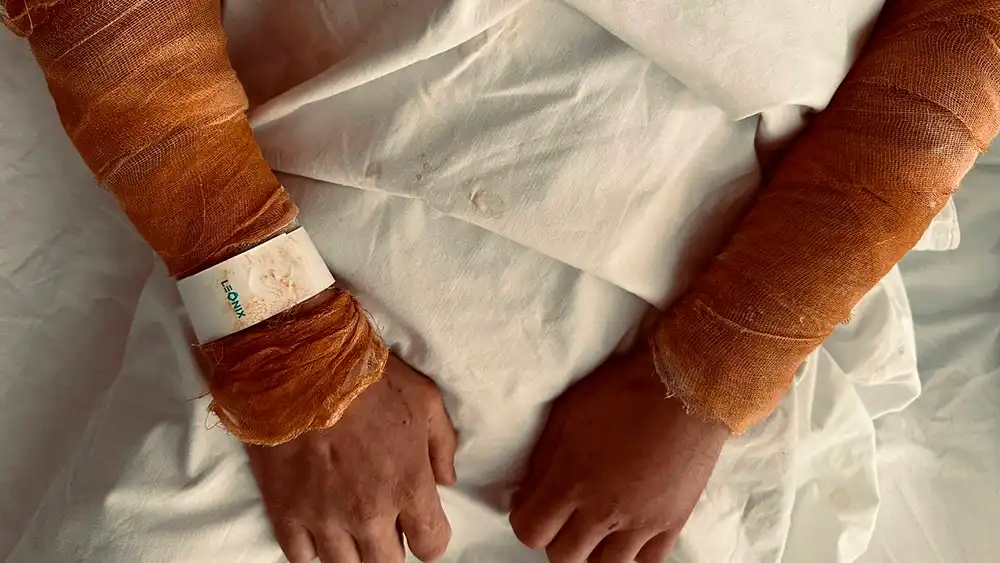 Перебинтованные руки после ожога