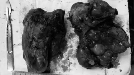 В РКБ Татарстана спасли женщину, 40 лет боявшуюся операции на щитовидной железе - телеканал НТР 24