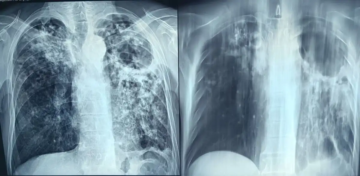 легкие на флюорограмме