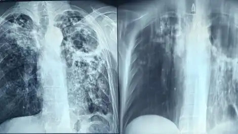 Флюорография спасает жизнь - телеканал НТР 24