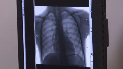 Врачи рассказали, как часто выявляют туберкулёз среди жителей Нижнекамска - телеканал НТР 24