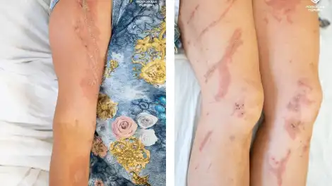ожоги на коже женщины